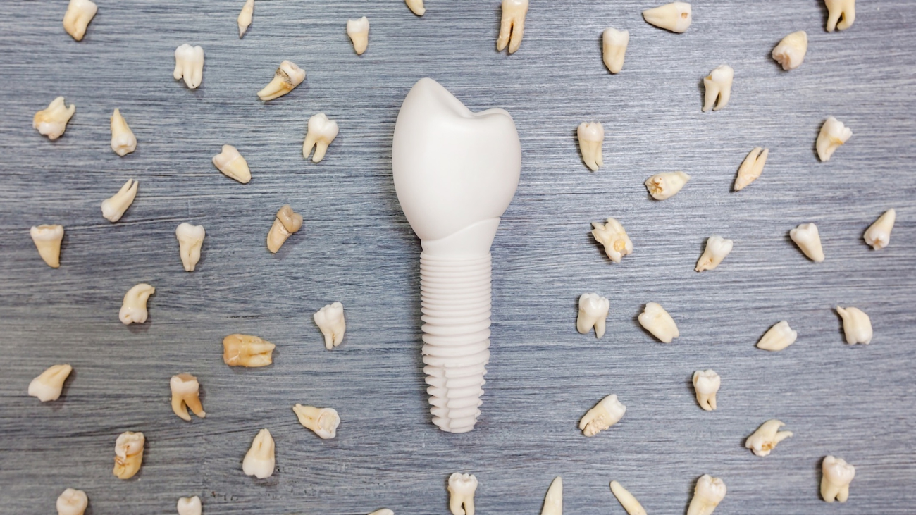 Implantes dentales